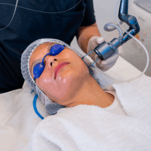 CO2 FRACCIONADO EN ROSTRO